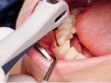 A session of VEKTOR therapy in the area of one tooth in «Denta.UA»
