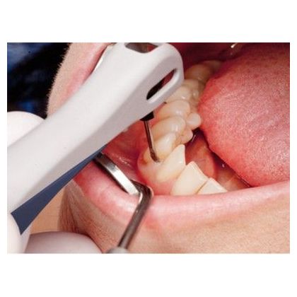 Сеанс VEKTOR-терапии в области одного зуба
