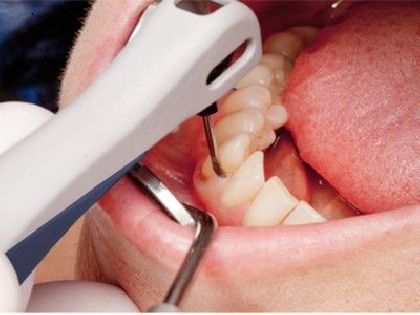 A session of VEKTOR therapy in the area of one tooth in «Denta.UA»