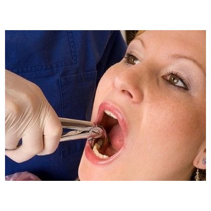 Removal of a tooth of the V category of complexity (the beginnings of wisdom teeth)