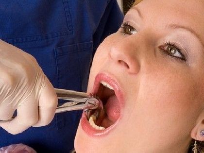 Видалення зуба V категорії складності  (зачатки зубів мудрості) у Стоматології «Дента.UA»