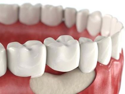 РВК в области одного зуба – фронтальная группа