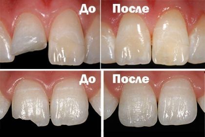 Пломбування зубів при середньому карієсі, фронтальний зуб