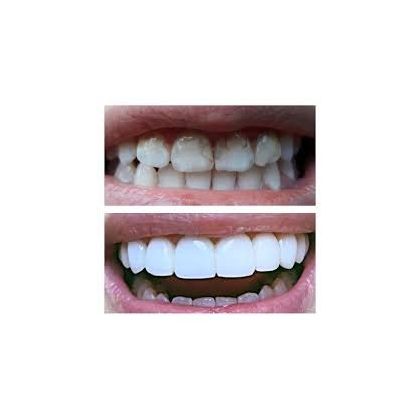 Пломбування зубів при глибокому карієсі, фронтальний зуб