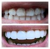 Filling of teeth with deep caries with damage to two or more surfaces, chewing tooth in «Denta.UA»