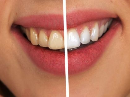 Teeth whitening procedure using carbamide peroxide solution (1 tooth)