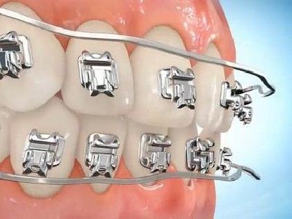 Replacement of elastic ligatures (1 jaw) in «Denta.UA»