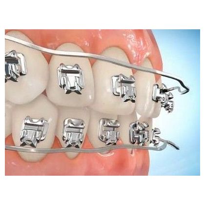 Removal of orthodontic equipment, fixation of metal retainer, polishing, fluoridation