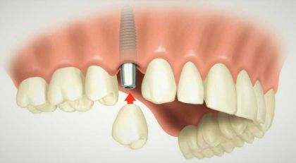 Gum shaper Strauman (Switzerland) in «Denta.UA»