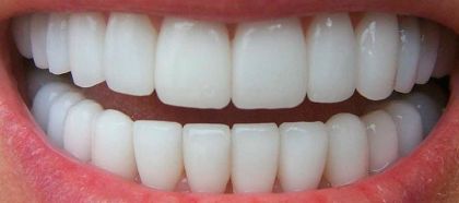 Metal-ceramic crown (frontal tooth)