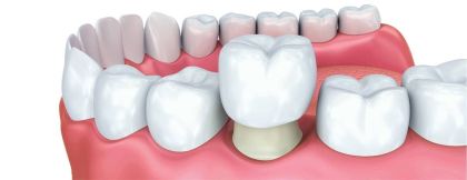 Metal crown as a structural element in «Denta.UA»
