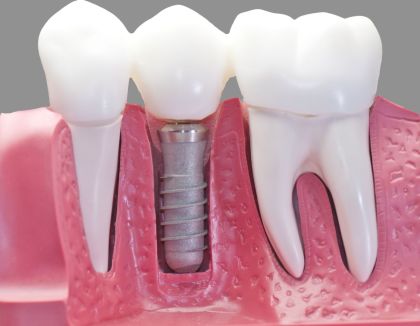 Коронка на імплант Dentium (Південна Корея) у Стоматології «Дента.UA»