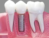 Implant crown Strauman (Switzerland) in «Denta.UA»