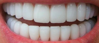 Ceramic crown (front tooth)