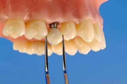 copy of A temporary crown is made in a laboratory in «Denta.UA»