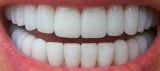 Zirconia crown Ivoclar Vivadent (front tooth) in «Denta.UA»