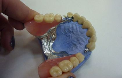 Bugel prosthesis with fixation on lock fasteners in «Denta.UA»