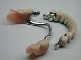 Bugel prosthesis with fixation on lock fasteners in «Denta.UA»