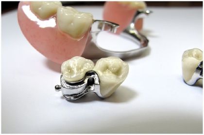 Bugel prosthesis with fixation on lock fasteners in «Denta.UA»