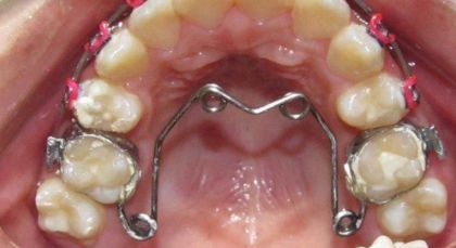 Palate buckle in «Denta.UA»