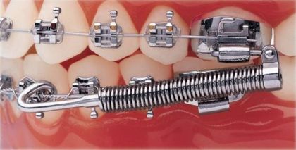Corrector II class Forsus in «Denta.UA»