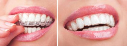 Treatment with transparent aligners of the I-category of complexity (up to 15 aligners)