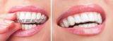 Treatment with transparent aligners of the II complexity category (from 15 to 25 aligners) in «Denta.UA»