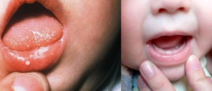Медикаментозная обработка при стоматитах и повреждениях полости рта