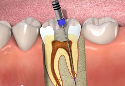 Filling of one root canal by the method of 3D obturation