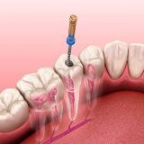 Unsealing of one root canal previously sealed with resocin-formalin, eugenol-containing pastes in «Denta.UA»