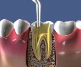 Sealing of one channel with sealers in «Denta.UA»