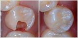 Filling of teeth with surface caries, chewing tooth in «Denta.UA»