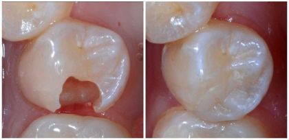 Пломбування зубів при поверхневому карієсі, жувальний зуб