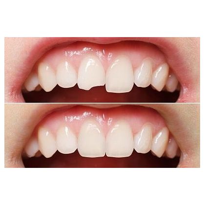 Пломбирование зубов при поверхностном кариесе, фронтальный зуб