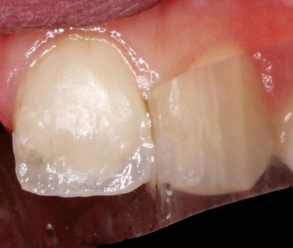 Aesthetic restoration (highly aesthetic restoration of incisors and canines using the composite material)