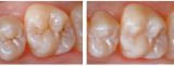 ᐉ Sealing of fissures of chewing teeth to prevent caries "Fissurit-F" (1 tooth) in Dentistry «Denta.UA»