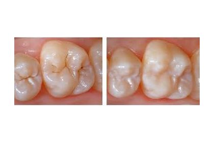 ᐉ Sealing of fissures of chewing teeth to prevent caries "Fissurit-F" (1 tooth) in Dentistry «Denta.UA»