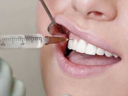 Плазмоліфтинг при локалізованих процесах в Стоматологии «Дента.UA»