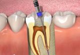 Filling of one root canal by the method of 3D obturation in «Denta.UA»