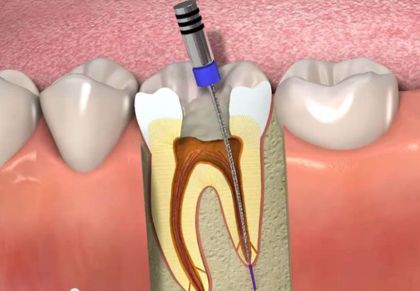 Filling of one root canal by the method of 3D obturation in «Denta.UA»