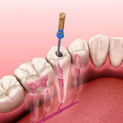 Unsealing of one root canal previously sealed with resocin-formalin, eugenol-containing pastes in «Denta.UA»