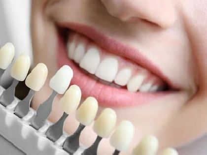 Ceramic veneer E-MAX in «Denta.UA»