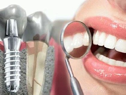 Операция по установке импланта системы Strauman SLActive (Швейцария) в Стоматологии «Дента.UA»