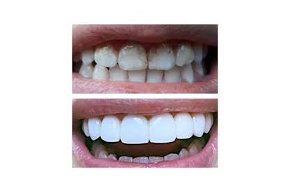 Filling of teeth with deep caries, chewing tooth in «Denta.UA»