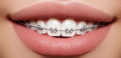 Initial consultation of a dentist-orthodontist (overview, panoramic shot, photo report)