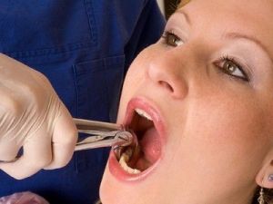 Видалення зубів, синус-ліфтинг, установка імплантів