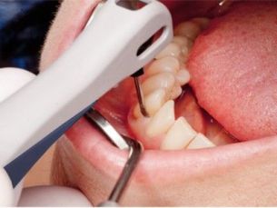 Periodontitis treatment, VECTOR-therapy, plazmolifting